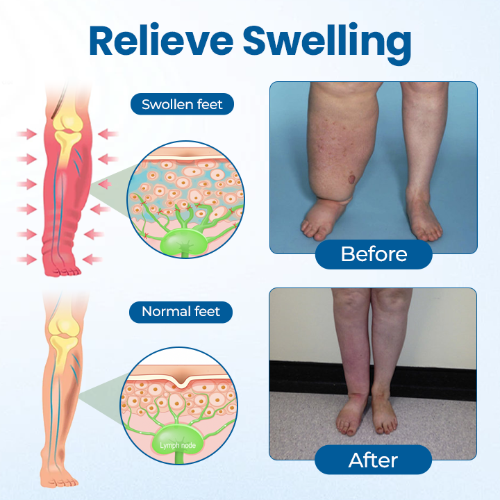 Timilk® Lymphora Swelling Relief Roll-On⭐