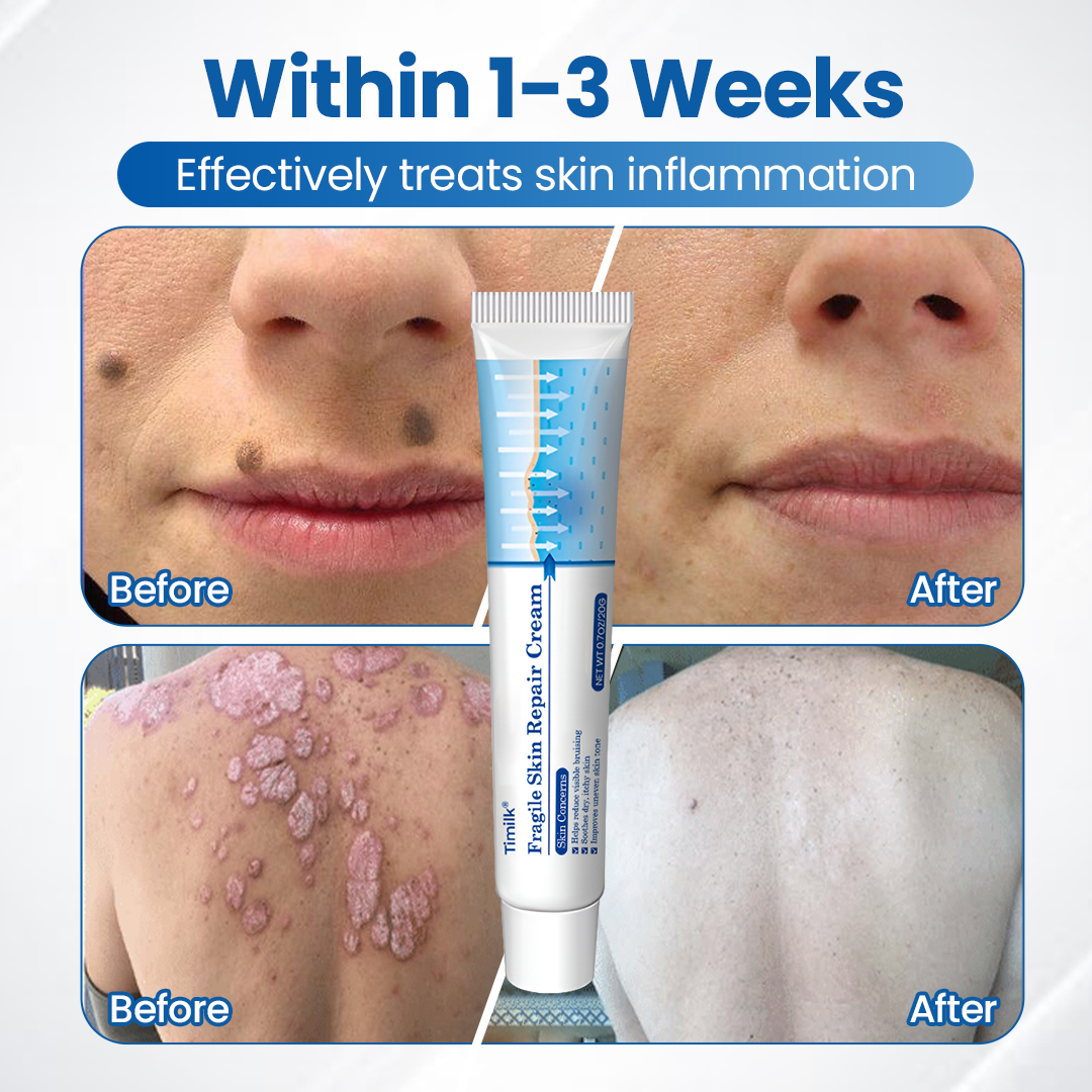 Timilk® Fragile Skin Repair Cream🛡️🌿 Multi-Repair for Bruises, Dryness & Spots