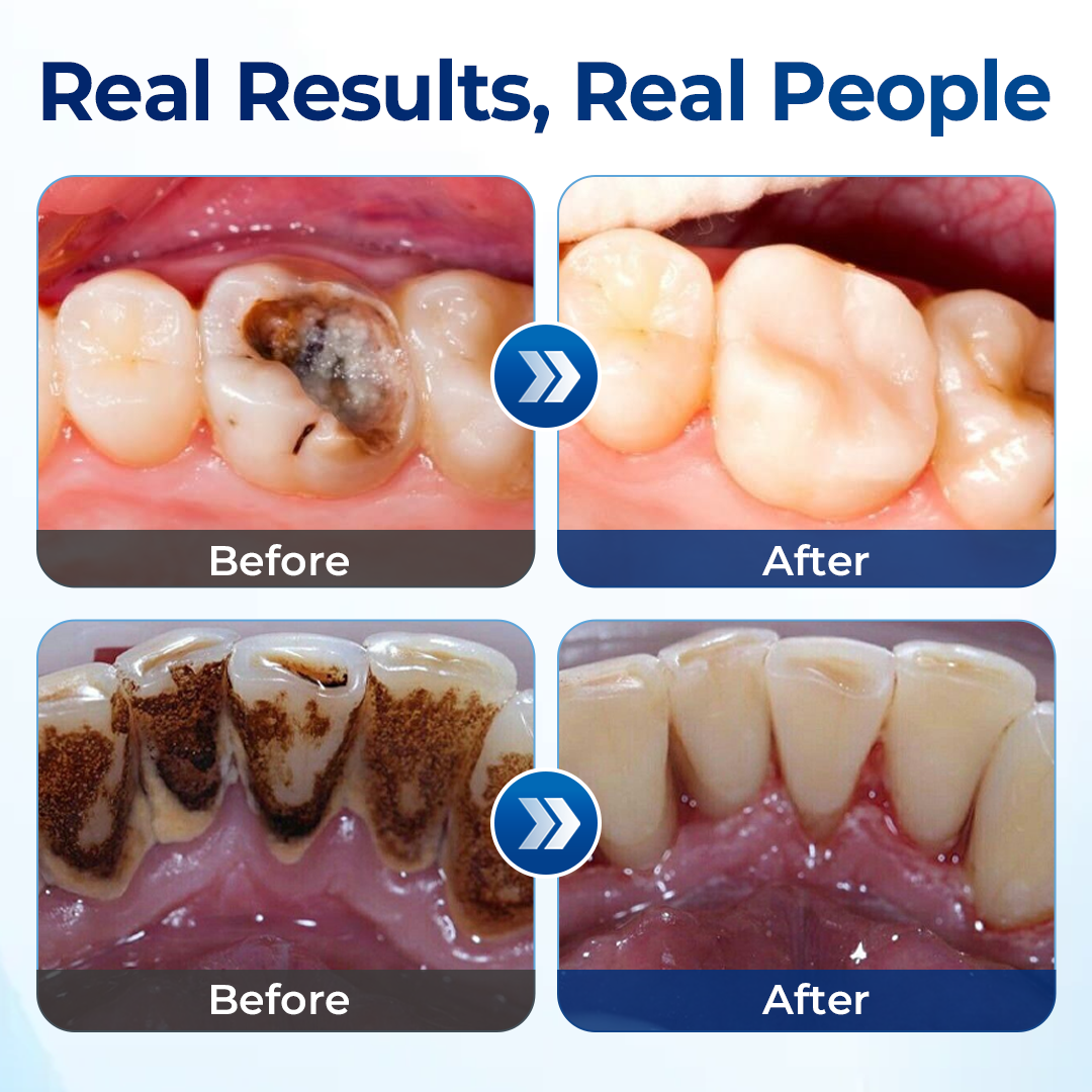 Mresio® RegenDent Advanced Tooth & Gum Renewal Device