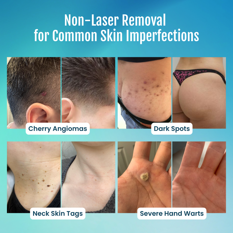 Timilk® SpotlessPro 7-Day Advanced Blemish & Tag Eraser